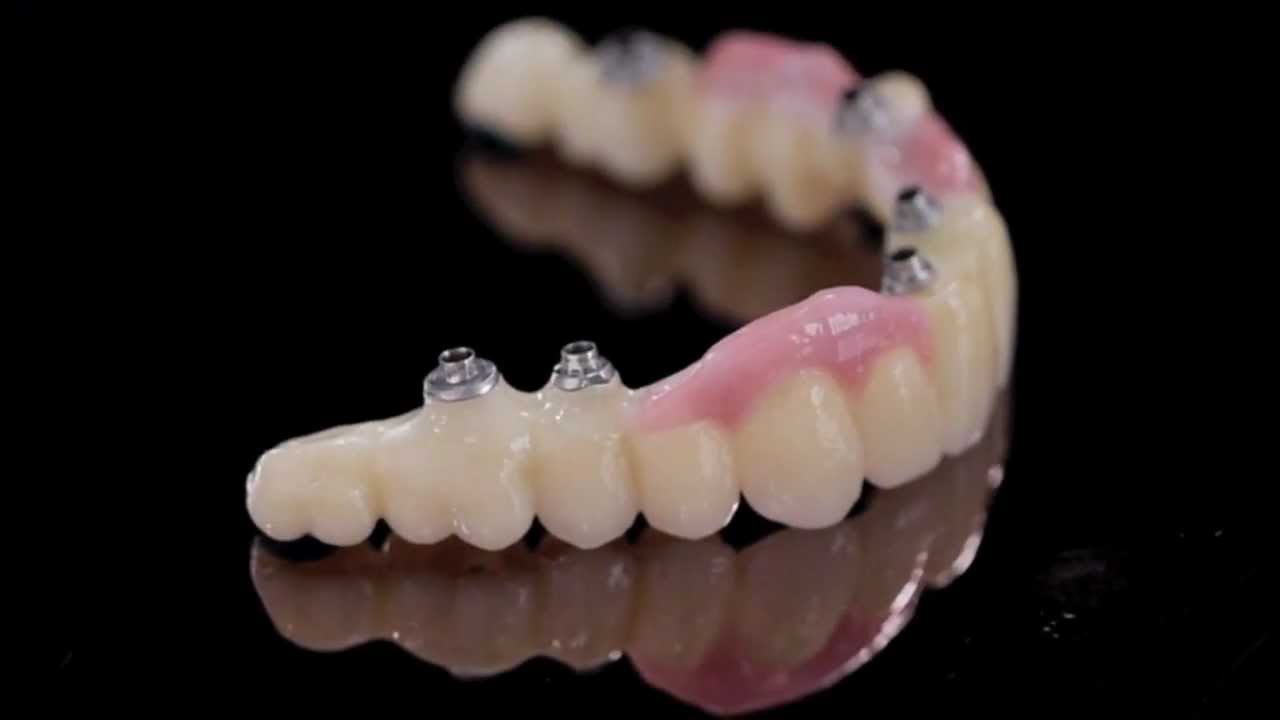 fixed- complete-denture